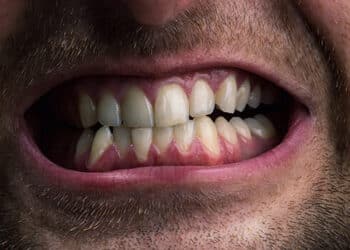 Conheça os sinais do bruxismo e proteja seus dentes agora