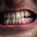 Conheça os sinais do bruxismo e proteja seus dentes agora